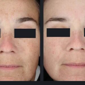 Nordlys SWT IPL Treatment